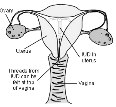 IUD